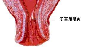 宫颈息肉图片