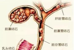 胆结石尿路结石食艾灸疗法