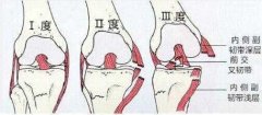膝关节炎疼痛难忍,艾灸四个穴位助缓解