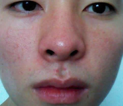 红鼻子艾灸的正确方法和穴位